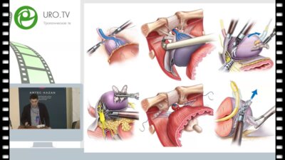 Осадчинский А.Е. - Пенильная реабилитация у пациентов, перенесших радикальную простатэктомию