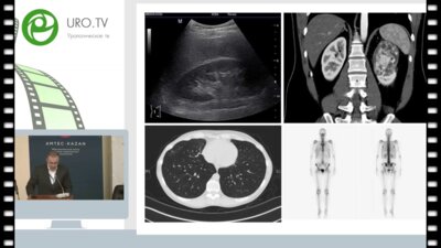 Семенов М.К. - Результаты лечения пациентов с почечно-клеточным раком, с распространением опухолевого тромба по венозной системе
