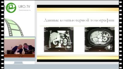 Михайликов Т.Г. - Лапароскопическая нефрэктомия с удалением тромба из нижней полой вены