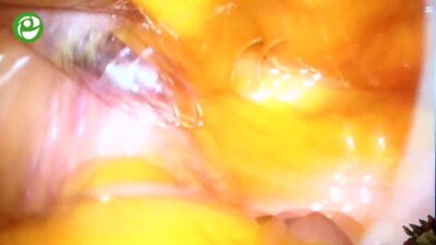 Галлямов Э.А. - Лапароскопическая парциальная нефрэктомия