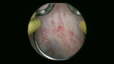 Мартов А.Г. - Биполярная трансуретральная резекция простаты