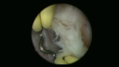 Мартов А.Г. - Биполярная трансуретральная электроэнуклеация простаты