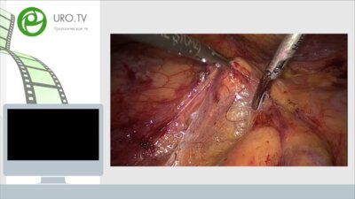 Робот-ассистированная резекция почки (В.Л. Медведев),  Лапароскопическая радикальная нефрэктомия (И.В. Михайлов), Нефроскопия, нефролитотрипсия (Г.Д. Дмитренко), Трансуретральная резекция опухоли мочевого пузыря (А.И. Стреляев)