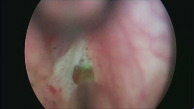 Андреас Гросс - Операция: Тулиевая энуклеация гиперплазии простаты (ВРН)