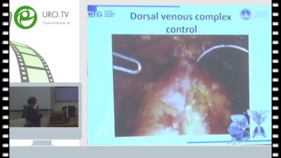 Pier Francesco Bassi - Robotic radical prostatectomy my preferred way
