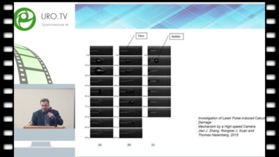 Дубровин В.Н. - Тулиевая лазерная литотрипсия