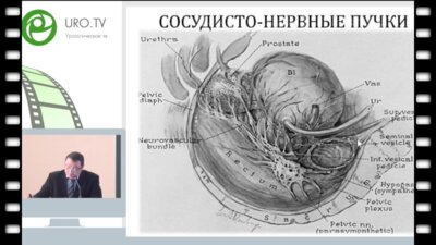 Невирович Е.С. - Радикальная простатэктомия с сохранением ретциевого пространства