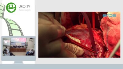 Понаморев А.В., Сирота Е.С., Шпоть Е.В. - Видеосессия живая хирургия