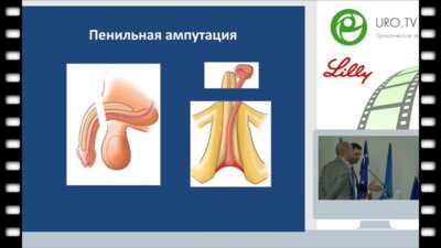 Кристофер Ллоренс  - Использование пенильных протезов