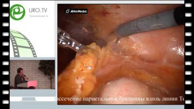 Шпоть Е.В. - Робот-асистированная резекция левой почки