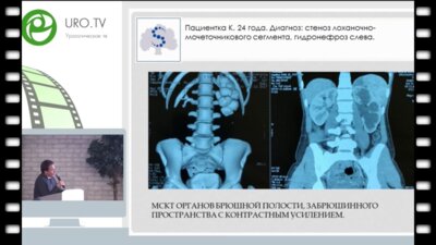 Шпоть Е.В. - Лапароскопическая уретерокаликостомия