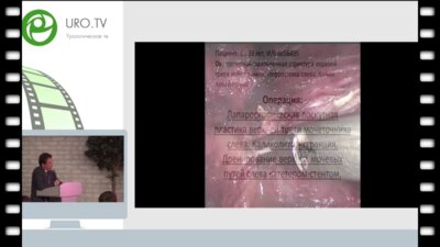 Шпоть Е.В. - Лапароскопическая лоскутная пластика верхней трети левого мочеточника