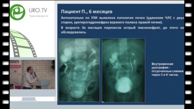 Каганцев И.М - Лапароскопический уретеропиелоанастомоз при обструкции ВУС верхнего полюса удвоенной правой почки