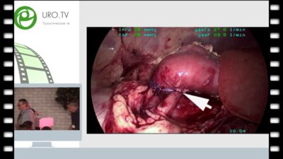 Бондаренко С.Г. - Особенности лапароскопической пиелопластики при гиперротации почки