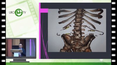 Малханов  Ш.В  - Опыт перкутанной хирургии в Забайкальском крае