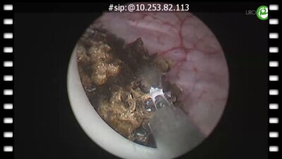 Тулиевая энуклеация простаты единым блоком