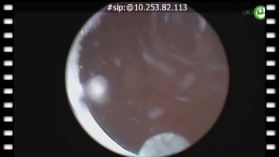 Болгов Е. Н. - Трансляция из операционной Тулиевая энуклеация простаты  – трехдолевая методика