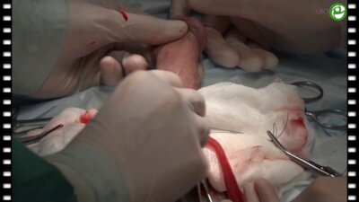 Болезнь Пейрони. Эректильная дисфункция. Фаллоэндопротезирование