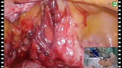 Лапароскопическая пластика мочеточника