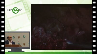 Гебенов М. Х.  - Лапароскопическая резекция при синхронном двустороннем опухолевом поражении