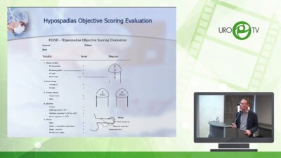 Батрутдинов Р.Т. - Уреопластика Inlay при первичной и повторной гипоспадии. Оценка результатов