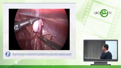 Карпачев С.А. - Наш опыт лапароскопических операций в практике детского уролога