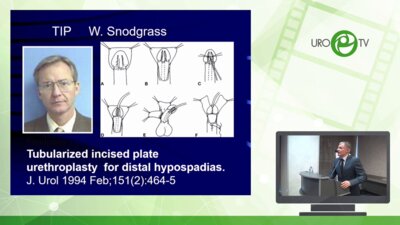 Рудин Ю.Э. - Аугментация головки полового члена у детей с гипоспадией. Показания, техника, результаты лечения