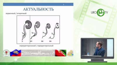 Хаертдинов Э.И. - Лапароскопическое удаление дивертикула мочевого пузыря и культи мочеточника