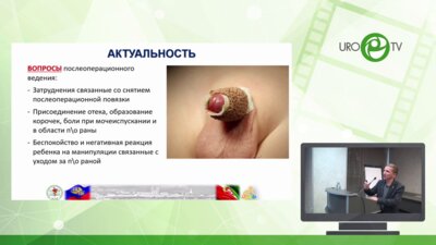 Хаертдинов Э.И. - Опыт использования N-БУТИЛ-2-ЦИАНОАРИЛАТ при Circumcision у детей