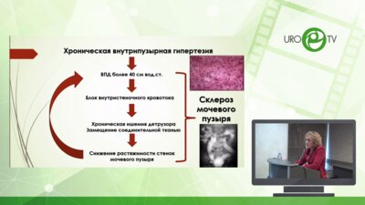 Щедрина А.Ю. - Применение ботулотоксина типа А в лечении редукции ёмкости и гиперактивности мочевого пузыря у детей