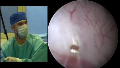 Дымов А.М. - Лазерная резекция опухоли мочевого пузыря единым блоком (en-bloc)