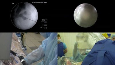 Мартов А.Г. - Лазерное удаление папиллярной опухоли верхних мочевыводящих путей (UTUC)