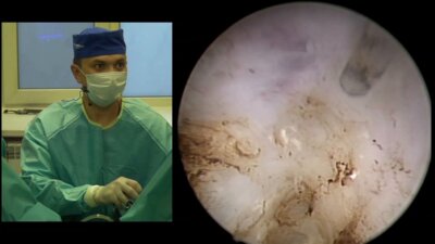 Сорокин Н.И. - Тулиевая волоконная энуклеация гиперплазии предстательной железы