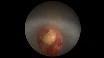 Цариченко Д.Г. - Перкутанная нефролитотрипсия (PCNL)
