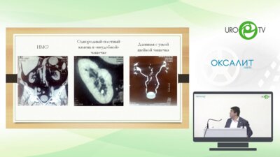 Акопян Г.Н. - Камень в нижней руппе чашечек 1,5 см - ДПТ против РИРС