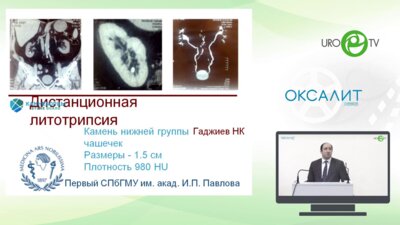 Гаджиев Н.К. - Камень в нижней руппе чашечек 1,5 см - ДПТ против РИРС