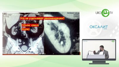 Мазуренко Д.А. - Камень в нижней руппе чашечек 1,5 см - ДПТ против РИРС