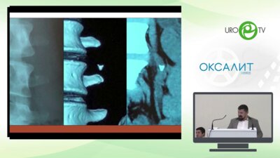 Мазуренко Д.А. - Камень верхней трети мочеточника  1 см - ДЛТ против Уретероскопии