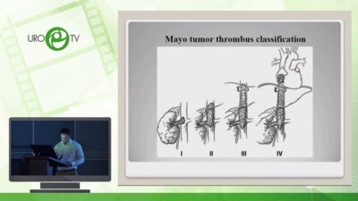 Богомолов О.А. - Возможность лапароскопического доступа при опухолевых тромбах нижней полой вены