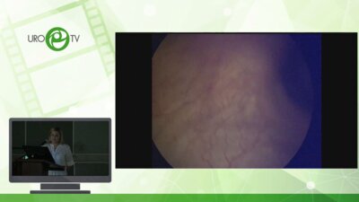 Попова М.Б. - Лапароскопическая резекция МП при экстрагенитальном эндометриозе