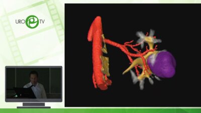 Шпоть Е.В. - Техника энуклеации опухоли почки в условиях нулевой ишемии