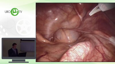 Шпоть Е.В. - Роботическая простатэктомия c 3-х слойной реконструкцией