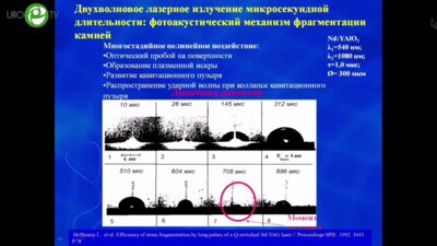Теодорович О.В.  Нарышкин С.А.  Борисенко Г.Г.  Шатохин М.Н.  Кочиев Д.Г.  Расщупкина Е.В. - Лазерные технологии в урологии
