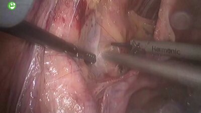 Галямов Э.А.  - Лапароскопическая простатэктомия 3D