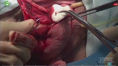 Каппушева Л.М. - Хирургическая коррекция тазового пролапса: задний компартмент из вагинального доступа