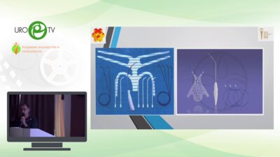 Правдин Е.В. - Методы использования лапароскопической пектопексии в коррекции тазовых пролапсов