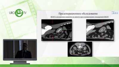 Сулейманов М.М. - Индивидуальный подход при планировании перкутанной нефролитотрипсии