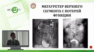 Доброседов Д.А. - Наш опыт применения лапароскопического доступа при лечении заболевания удвоенной почки у детей