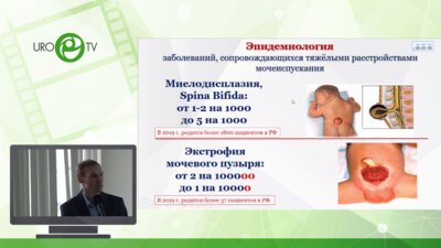 Сарычев С.А. - Операция Митрофанова у детей - инвестиция в будущее