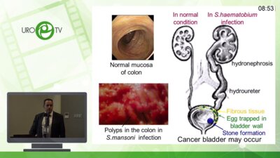 Старцев В.Ю. - Роль специфического шистосомного воспаления уротелия в развитии плоскоклеточного рака мочевого пузыря